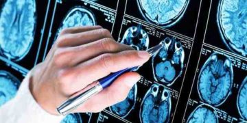 Japoneses investigan fármaco que evita en un 27% el deterioro cognitivo del alzheimer y la demencia